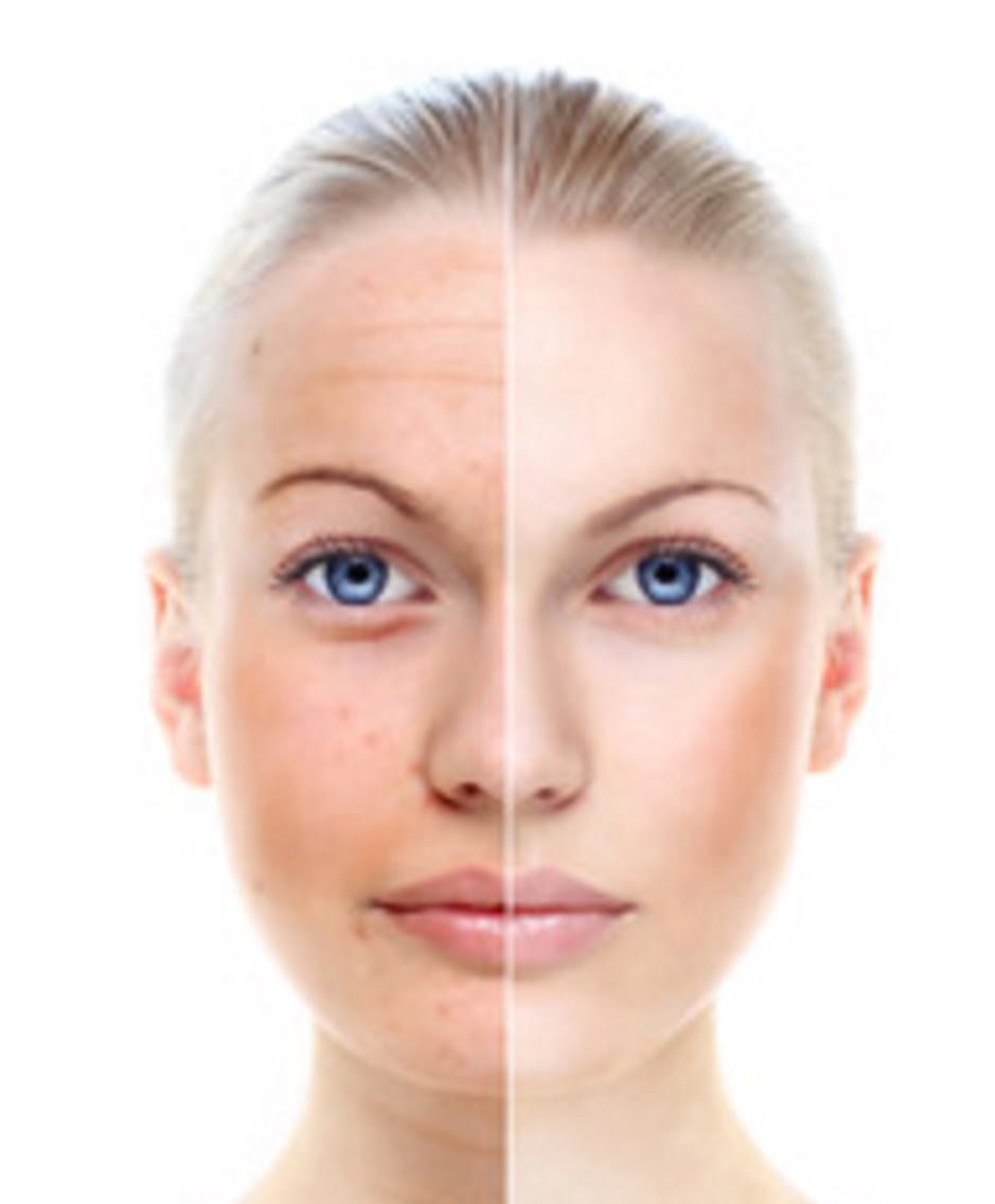 Aknės gydymas lazeriu