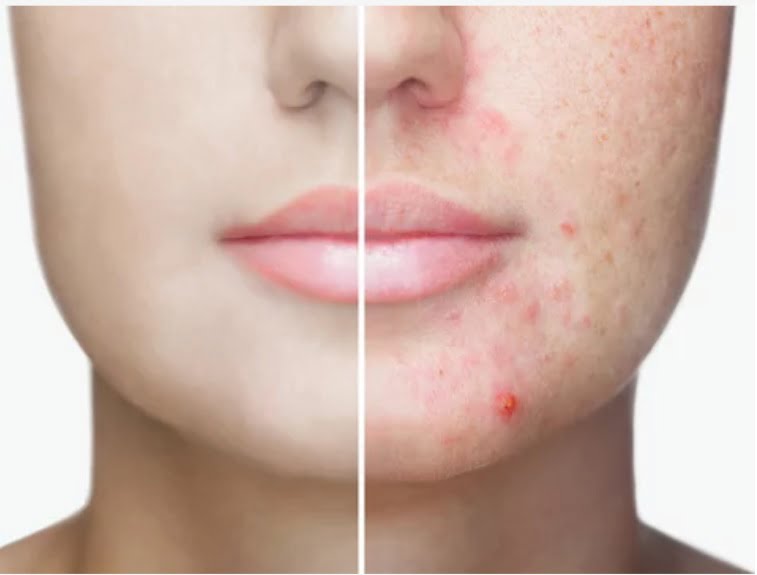Aknė arba paprastieji spuogai
