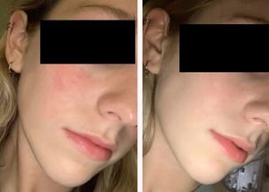 Intensyvios pulsinės &scaron;viesos (IPL) terapija