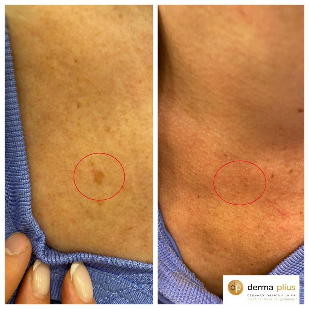 Pigmentinių dėmių &scaron;alinimas 4 PICO lazeriu