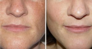 Intensyvios pulsinės &scaron;viesos (IPL) terapija