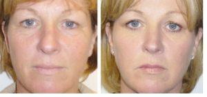 PRP &ndash; terapija trombocitais praturtintos plazmos injekcijomis