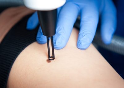 Lazerinė dermatologija Vilniuje