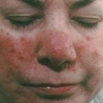 Rožinės diagnostika ir gydymas Vilniuje