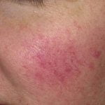 Rožinės diagnostika ir gydymas Vilniuje