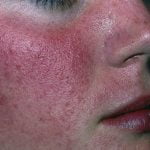 Rožinės diagnostika ir gydymas Vilniuje