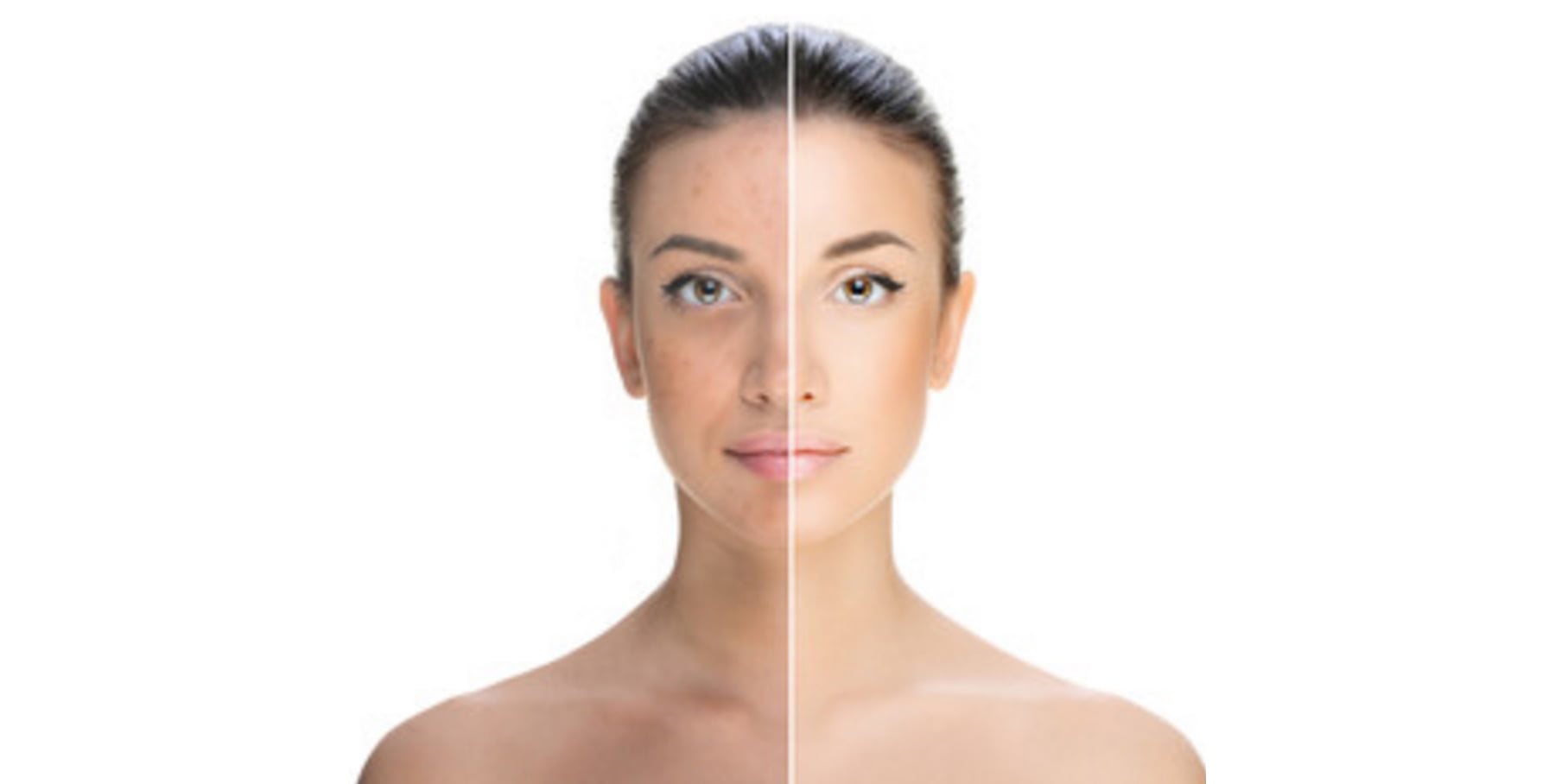 Rožinės aknės gydymas dermatologijoje