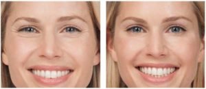 Rauk&scaron;lių korekcija botulino toksinu