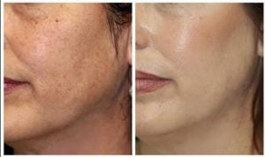 Deimantinė dermabrazija