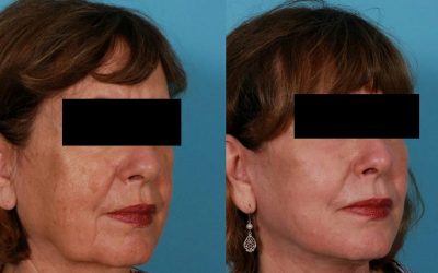 Deimantinė dermabrazija