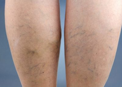 Lazerinė dermatologija Vilniuje