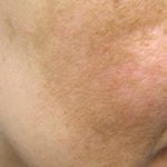 Pigmentacijos sutrikimų diagnostika ir gydymas Vilniuje