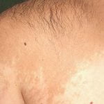 Pigmentacijos sutrikimų diagnostika ir gydymas Vilniuje