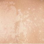 Pigmentacijos sutrikimų diagnostika ir gydymas Vilniuje