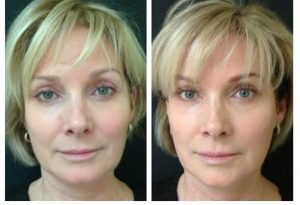 PRP &ndash; terapija trombocitais praturtintos plazmos injekcijomis