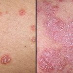 Žvynelinės diagnostika ir gydymas Vilniuje