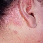 Žvynelinės diagnostika ir gydymas Vilniuje