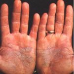 Žvynelinės diagnostika ir gydymas Vilniuje