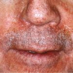 Seborėjinio dermatito gydymas Vilniuje