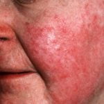 Seborėjinio dermatito gydymas Vilniuje