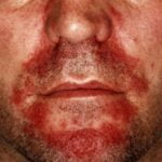 Seborėjinio dermatito gydymas Vilniuje