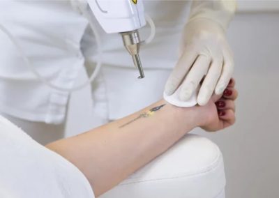Tatuiruočių &scaron;alinimas lazeriu