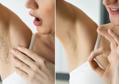 Ilgalaikis plaukelių &scaron;alinimas